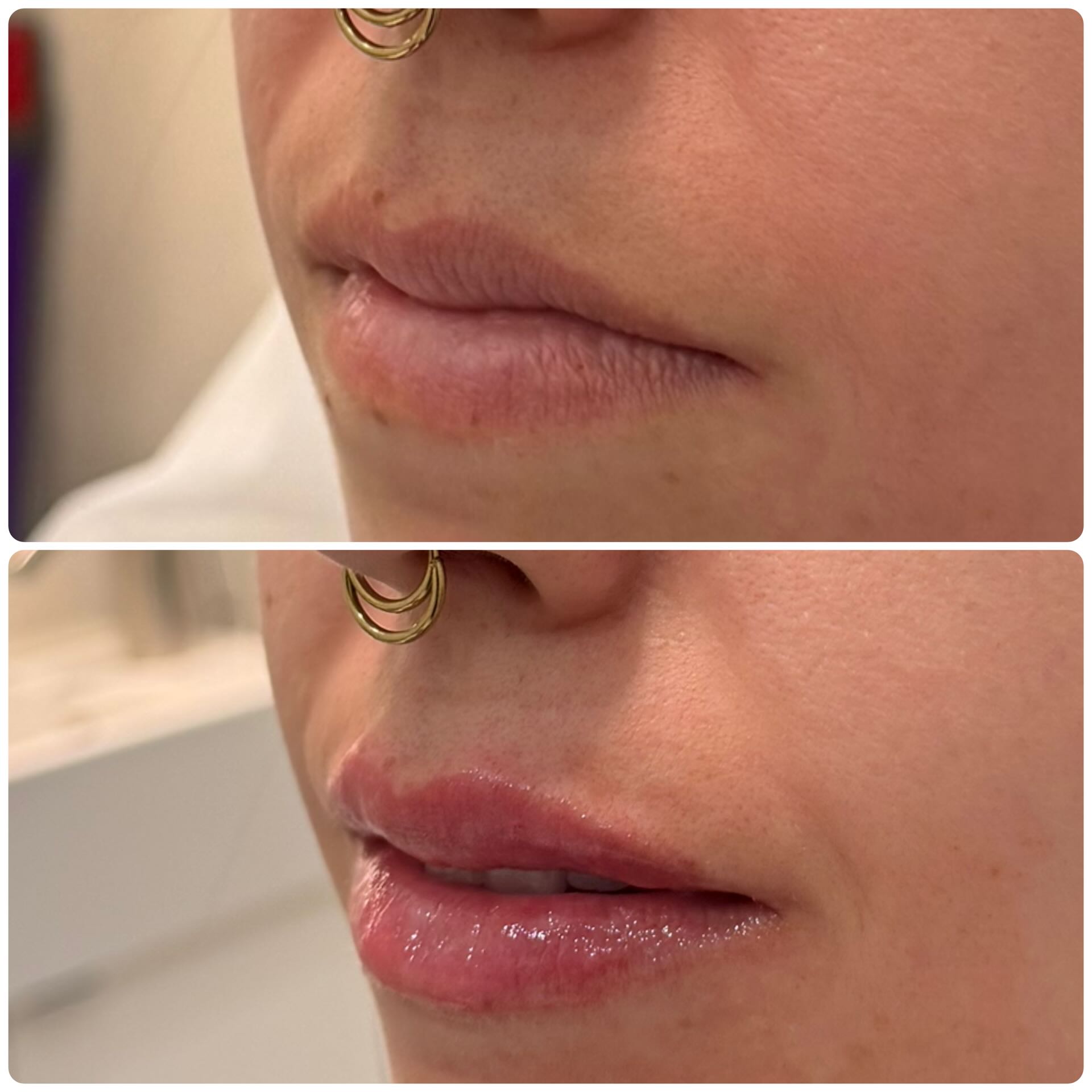 Lip contour improvement with dermal fillers before and after – after