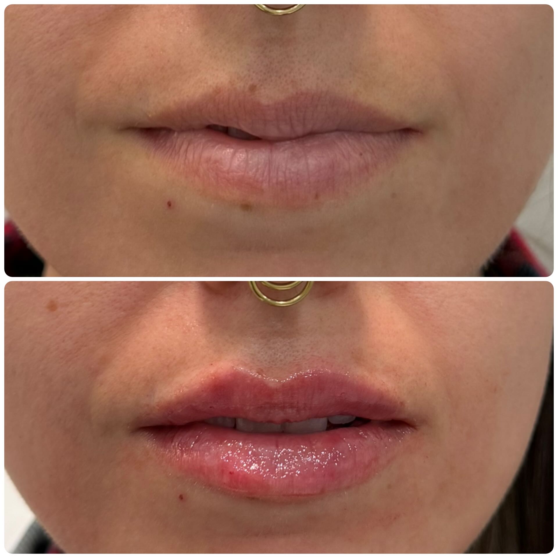 Natural lip plumpness filler treatment before and after Mississauga – after