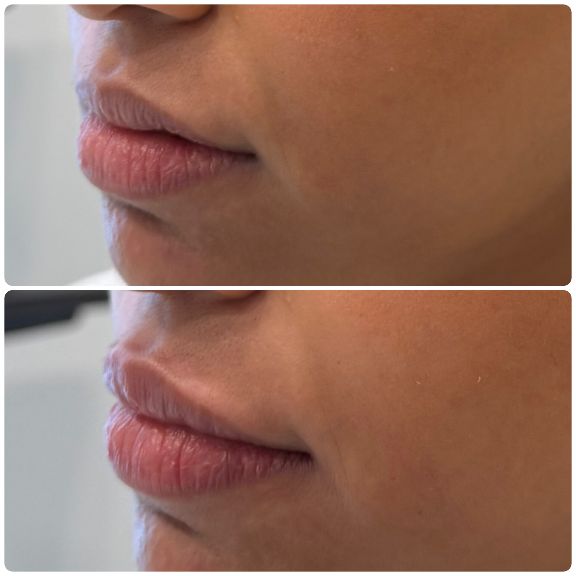 Lip filler natural enhancement before and after results RK Medical Aesthetics Mississauga – after