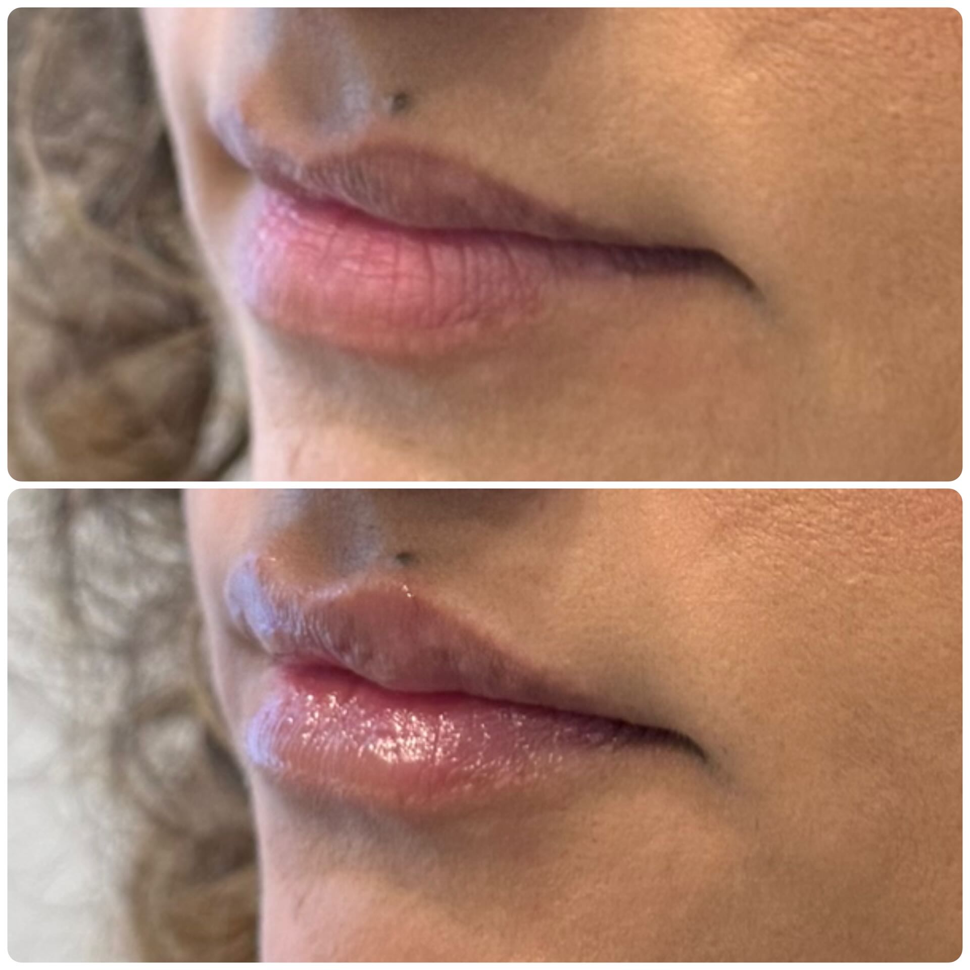 Lip augmentation dermal filler before and after Mississauga – after